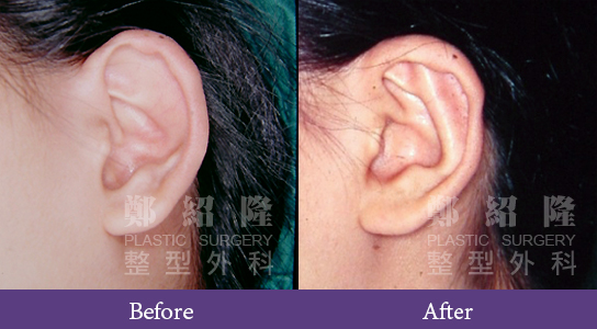 ear002