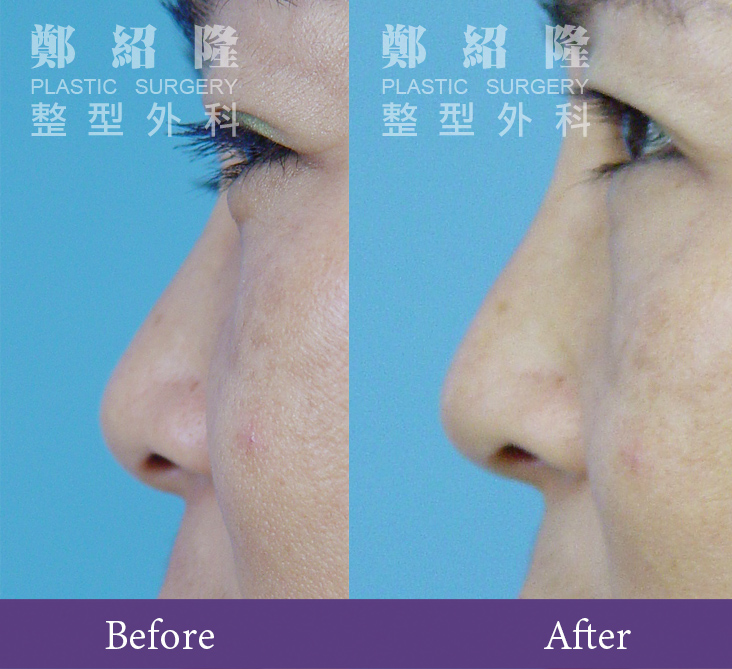 rhinoplasty001 1.jpg