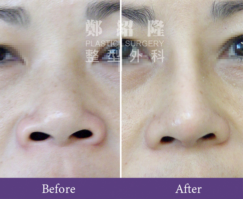 rhinoplasty001