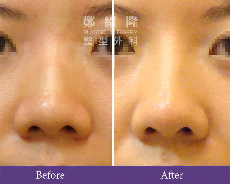 rhinoplasty003
