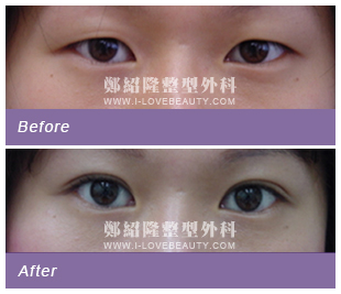 blepharoplasty002