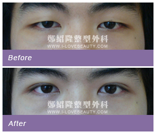 blepharoplasty003