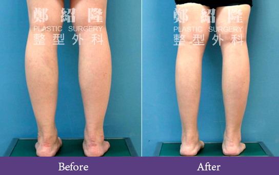 muscularlegs002 1
