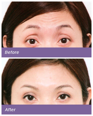 botox injection003 1