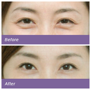 botox injection004 1