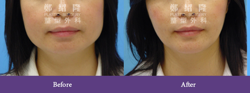 botox injection005