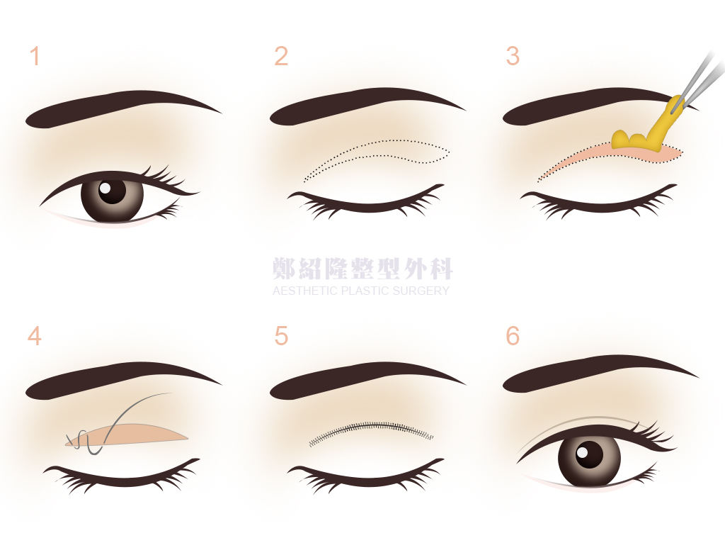 eye sample cut