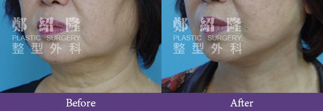 Face001