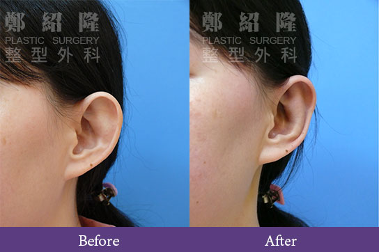 ear001 1