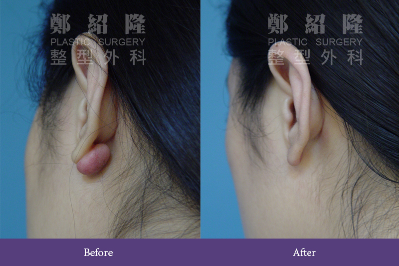 ear001