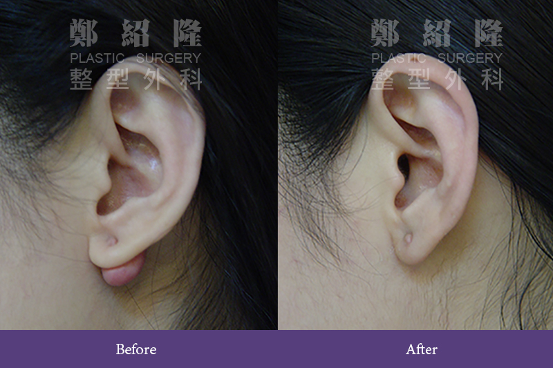ear002